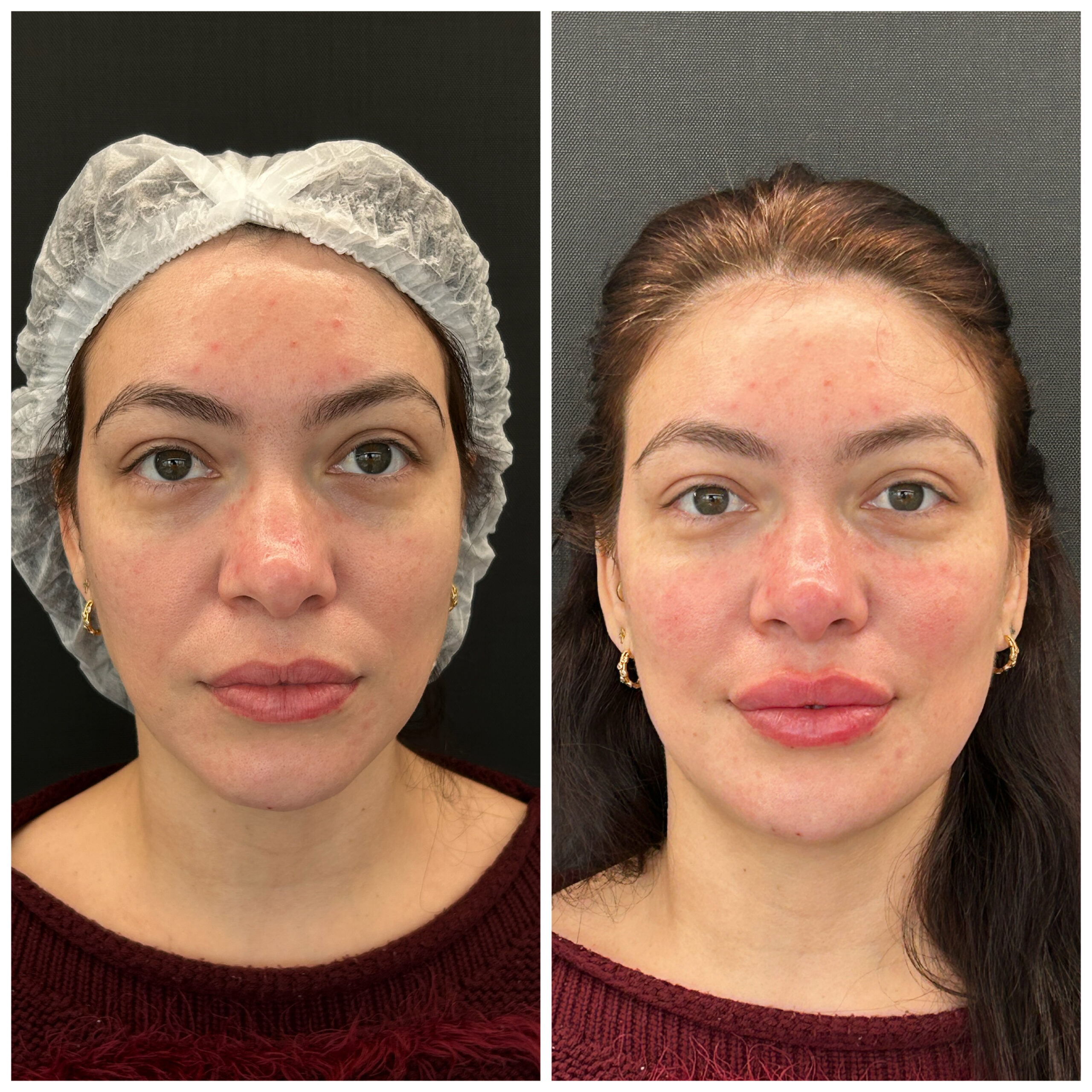 Resultado Preenchimento Labial