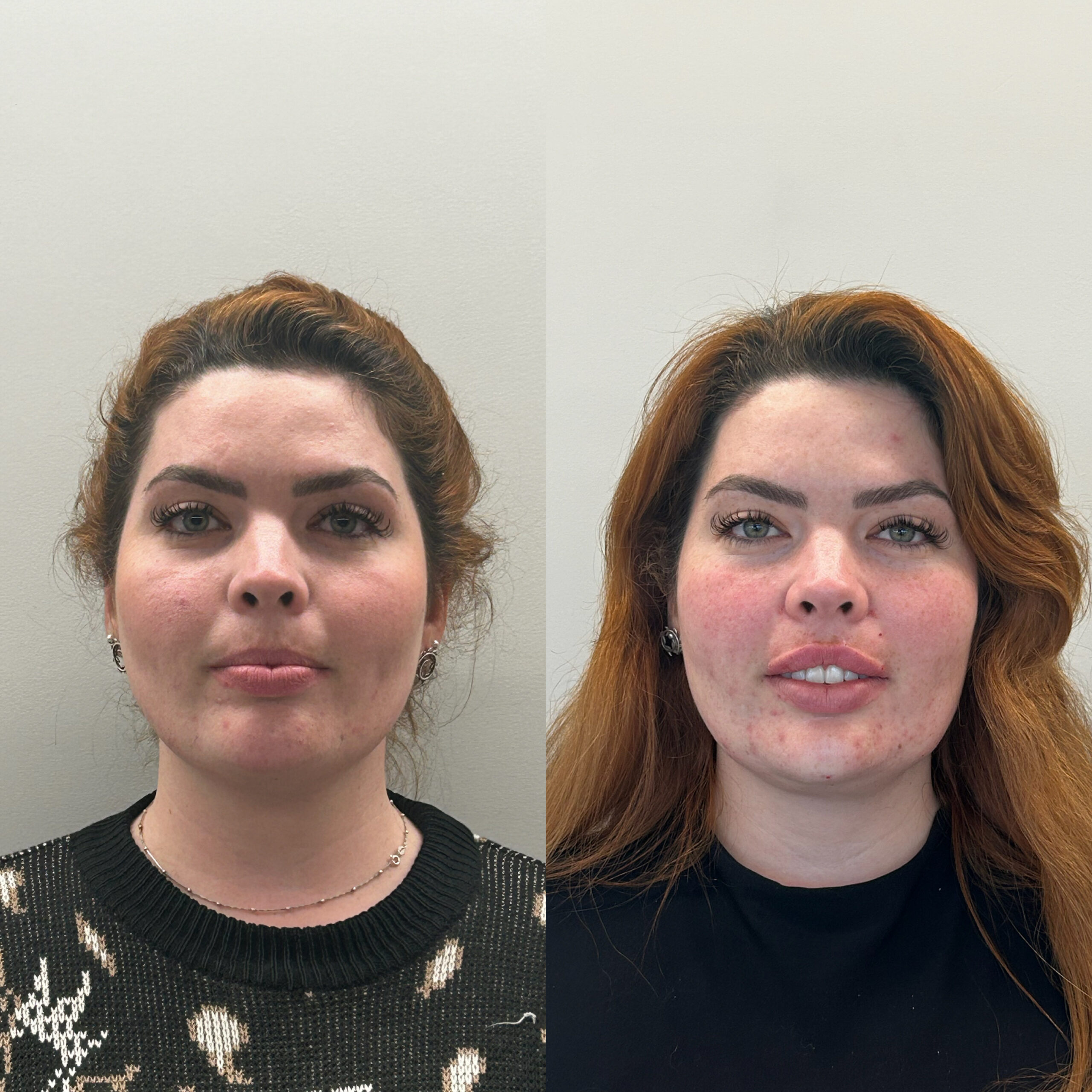 Resultado Harmonização Facial