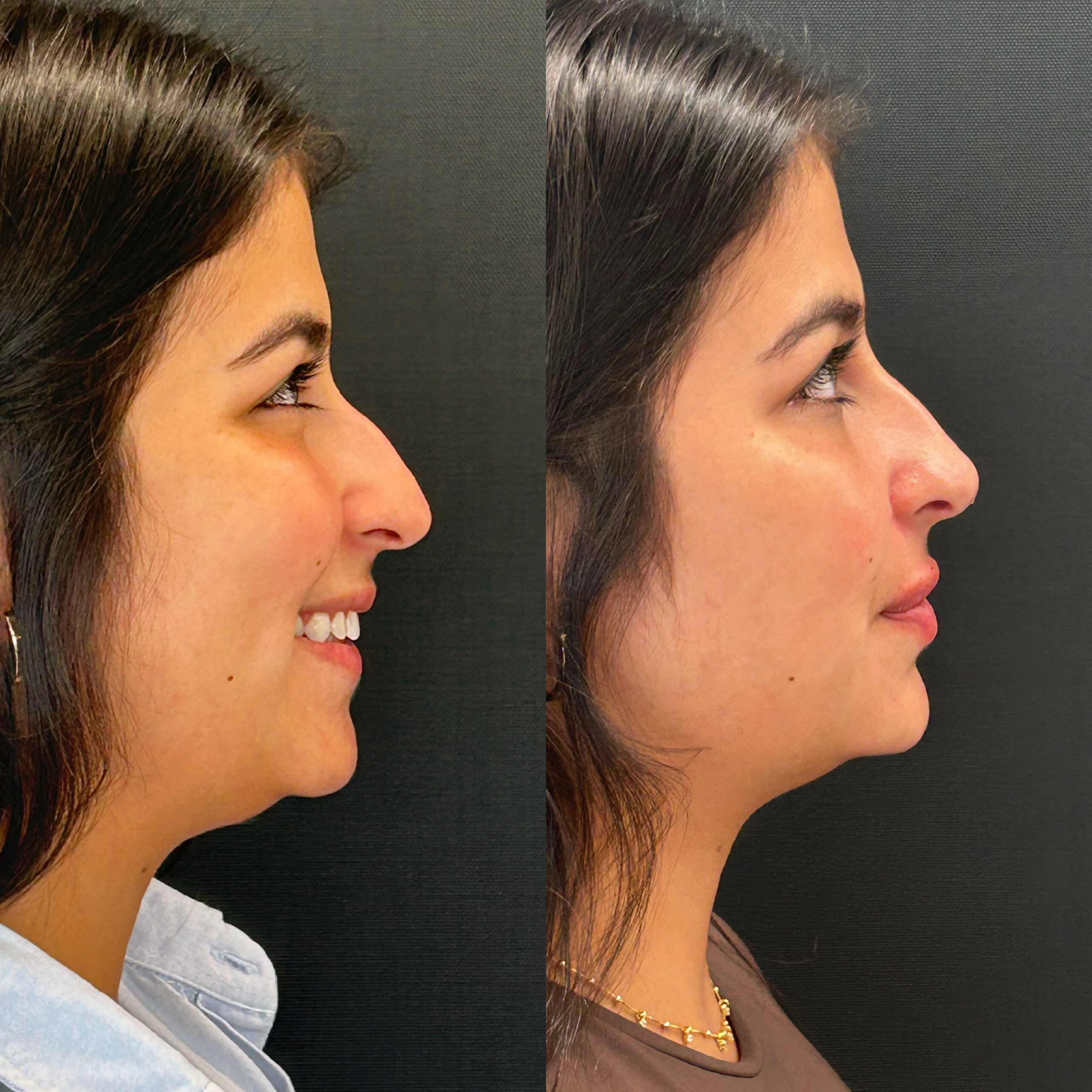 Resultado Contorno Mandibular