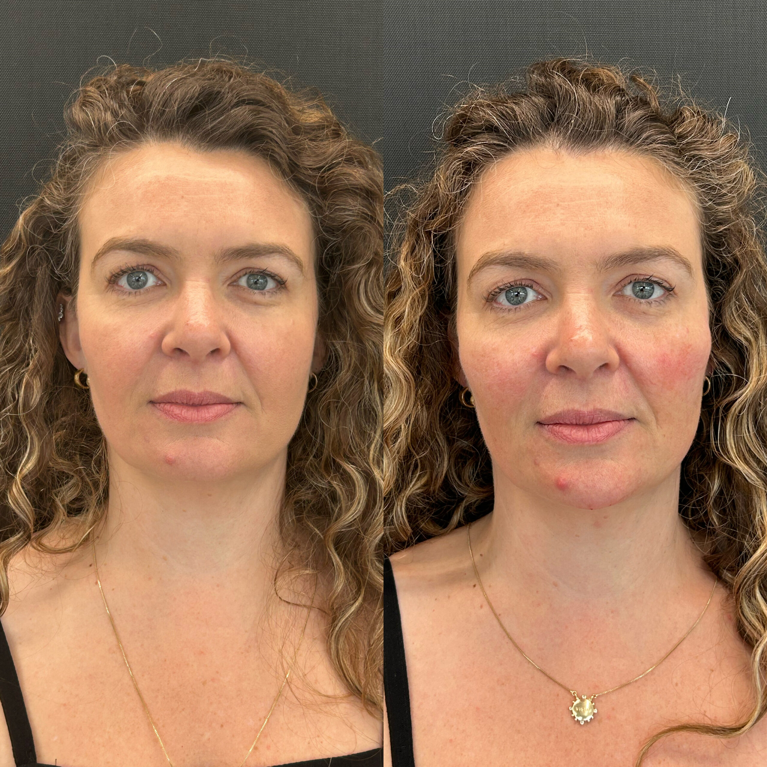 Resultado Bioestimulador de Colágeno